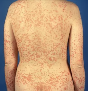 La psoriasis como humedecer el cuero cabelludo